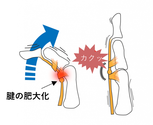 バネ指 |ばね指|適応症状|はりきゅうおんしん堂|稲美町