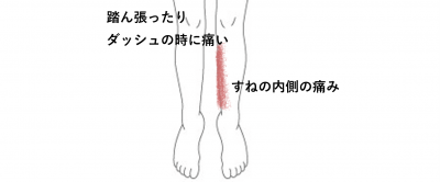 踏ん張った時にすねの内側が痛い | スポーツ疾患