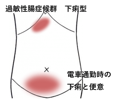 人間関係のストレスからIBSに | 過敏性腸症候群