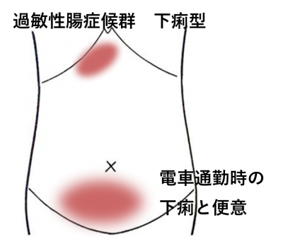人間関係のストレスからIBSに | 過敏性腸症候群