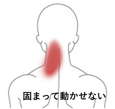 首が固まって動かせない | 首から上の症状
