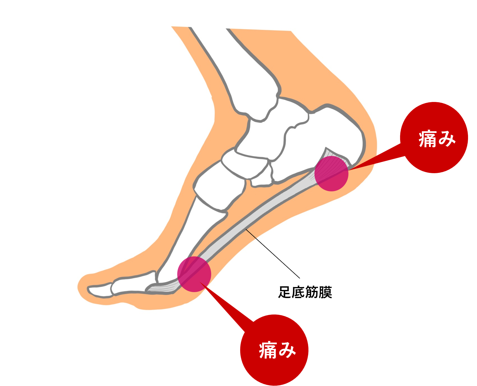 足底筋膜炎4招改善！症狀、治療和復健全圖解 | 腳跟痛 | 足底筋膜炎復健 | 足底筋膜炎治療 | 大紀元