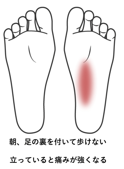 朝起きた時足の裏をついて歩けない/立っていると痛みが強くなる | 手足・腰の痛み、しびれ