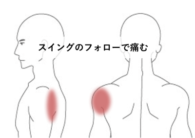 野球のスイングのフォローで痛む | スポーツ疾患