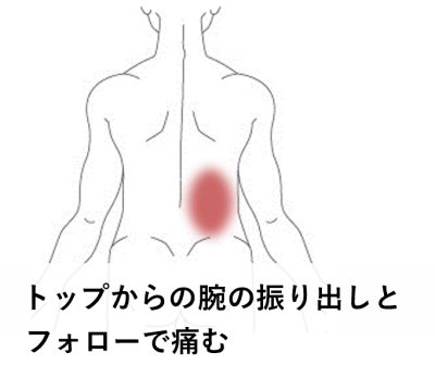 投手・トップからの振り出しとフォローで痛む | スポーツ疾患