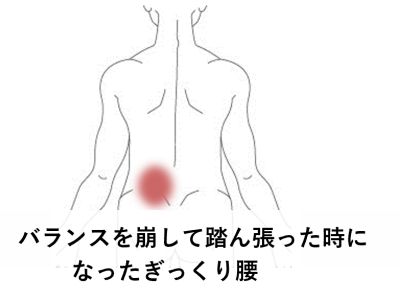 バランス崩し踏ん張った時になったぎっくり腰 | 腰痛