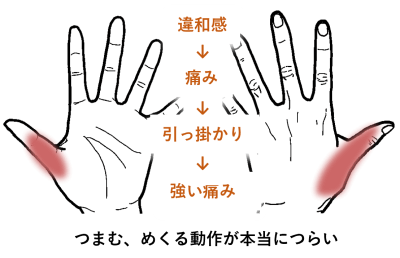 つまむ、めくる動作が本当に辛い | 手足・腰の痛み、しびれ