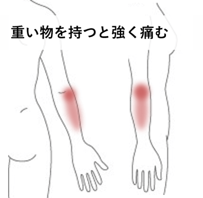 重い物を持つと強く痛む | 手足・腰の痛み、しびれ