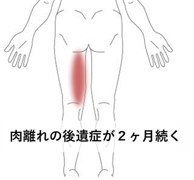 野球の試合で起きた肉離れの後遺症が2ヶ月続く | スポーツ疾患