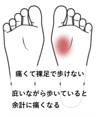 足底筋膜炎 セール 靴のかたさ