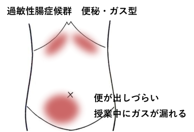 便が出しづらい・授業中にガスが漏れる | 消化器症状