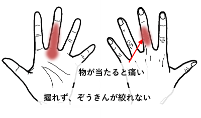 物が当たると痛い、握れず雑巾が絞れない | 【ばね指】患部だけでなく体全体を根気よく治療してくれる