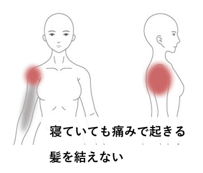 寝ていても痛みで起きる・髪を結えない | 【五十肩】初回で動きがスムーズに! 違和感、不調は少しでも早くがおすすめ!