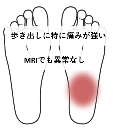 歩き出しに強い痛み・MRIで異常なし | 【足底筋膜炎】湿布を貼るくらいしかなかったのに助かった